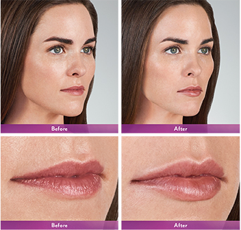 juvederm before and after Fort Lauderdale