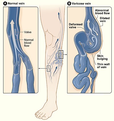 Varicose Veins Fort Lauderdale