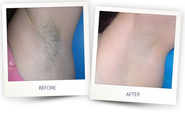 How Does Laser Hair Removal Work? | Fort Lauderdale Laser Hair Removal |  Baltic Beauty Centre