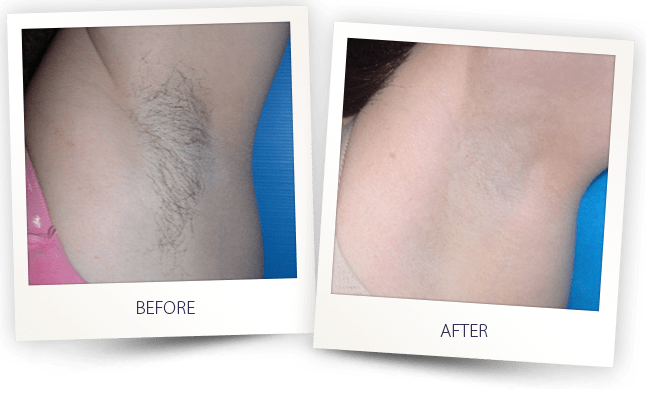 How Does Laser Hair Removal Work? | Fort Lauderdale Laser Hair Removal |  Baltic Beauty Centre