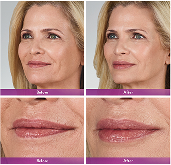 juvederm before and after Fort Lauderdale