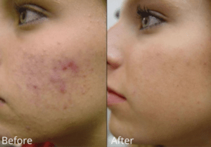 Microneedling Fort Lauderdale