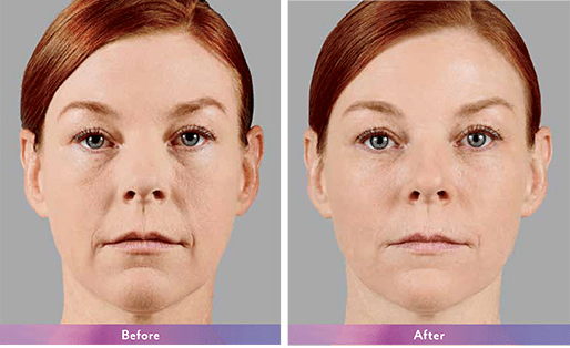 Juvederm Voluma Fort Lauderdale