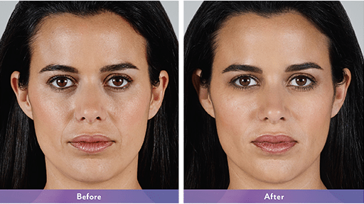 Juvederm Vollure Fort Lauderdale