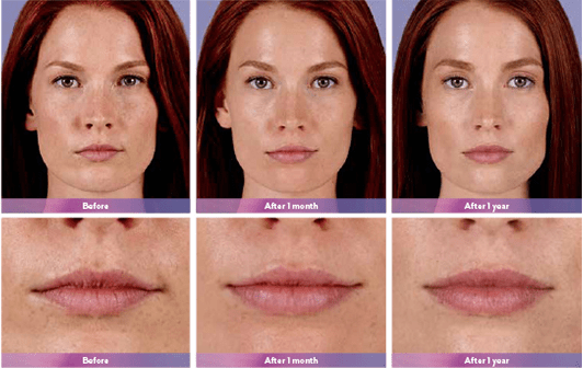 Juvederm Ultra Plus Fort Lauderdale