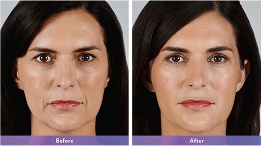 Juvederm Vollure Fort Lauderdale