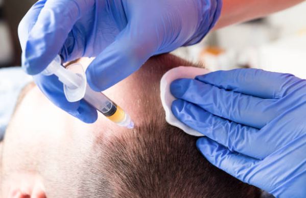 PRP hair loss treatment Fort Lauderdale