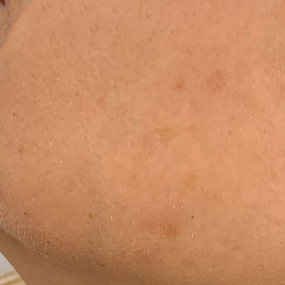12_Pigment_spot_laserremoval_after