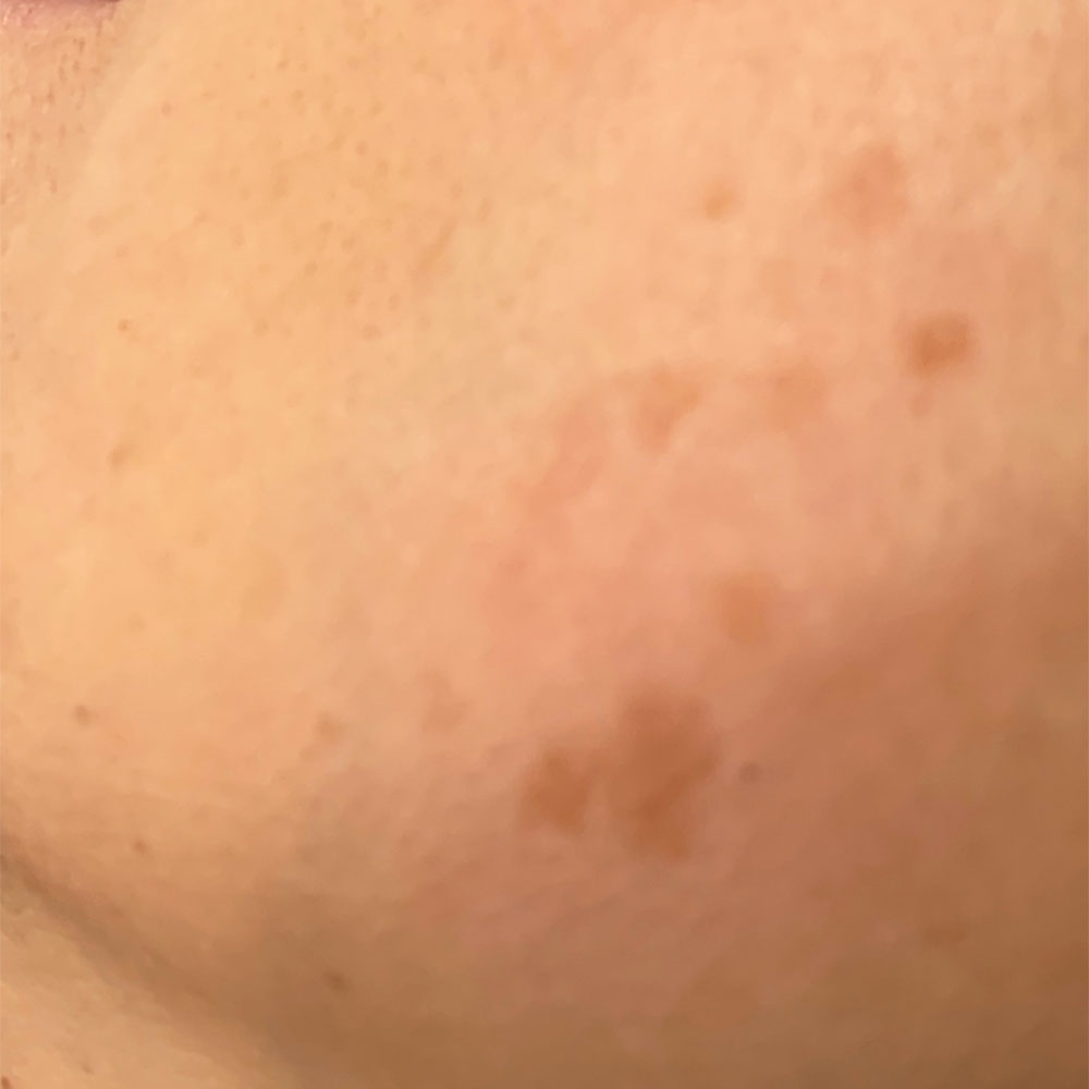 12_Pigment_spot_laserremoval_before