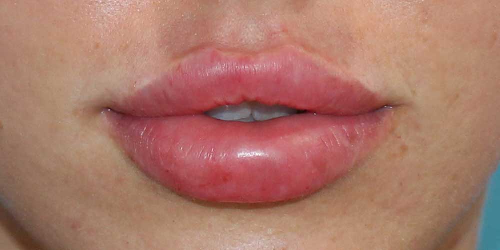 5_lip_fillers_after