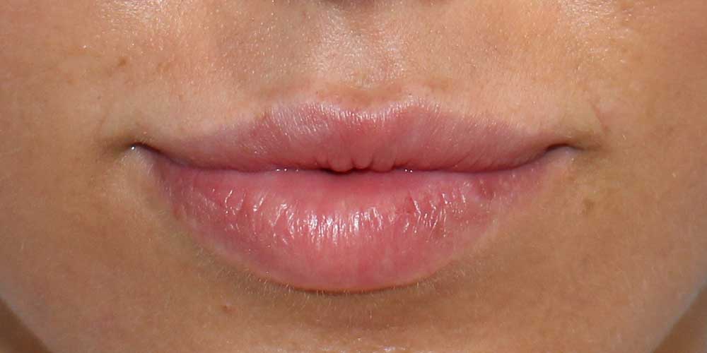 5_lip_fillers_before