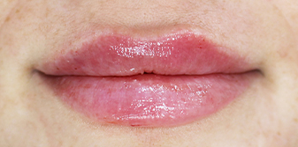 lips after 2