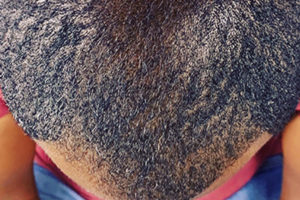 Scalp tattooing for hair loss