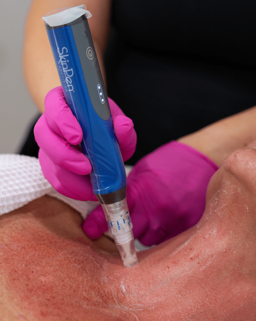 SkinPen microneedling
