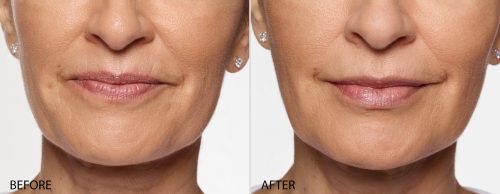 Restylane Silk Before and After 2016_Carol_FF