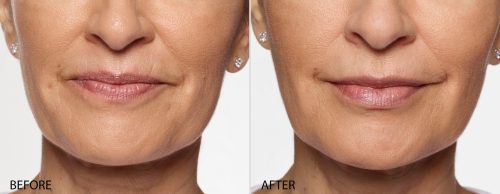 Restylane Silk Before and After 2016_Carol_FF Restylane Silk Before and After 2016_Carol_FF