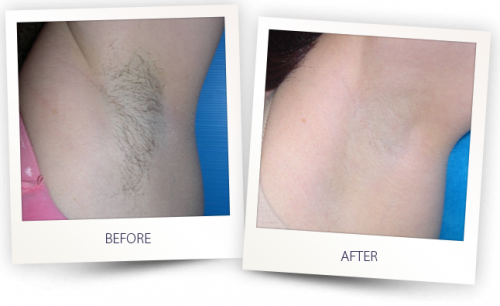 Laser Hair Removal Fort Lauderdale
