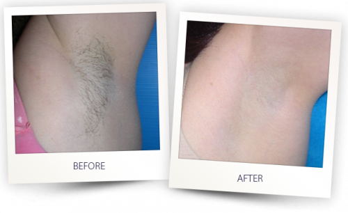 Laser Hair Removal Fort Lauderdale Laser Hair Removal Fort Lauderdale