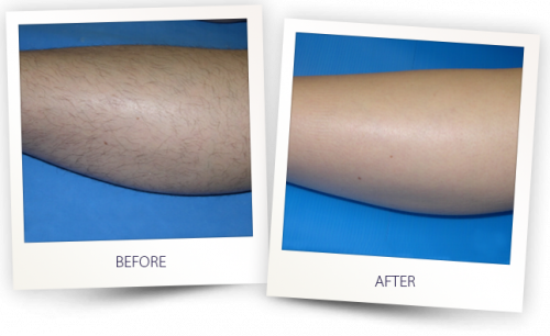 Laser Hair Removal Fort Lauderdale
