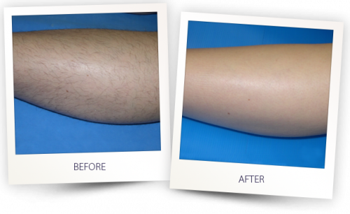 Laser Hair Removal Fort Lauderdale Laser Hair Removal Fort Lauderdale