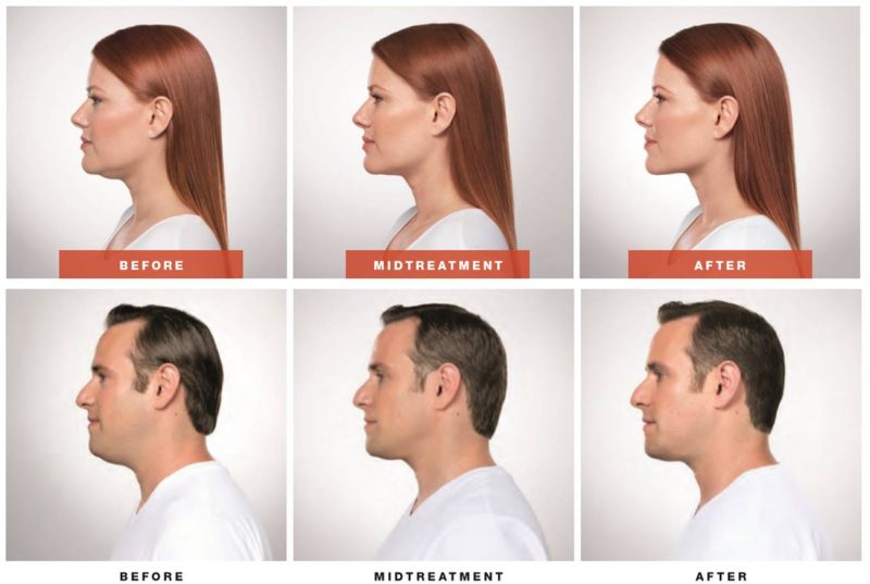 Kybella Fort Lauderdale Kybella Fort Lauderdale