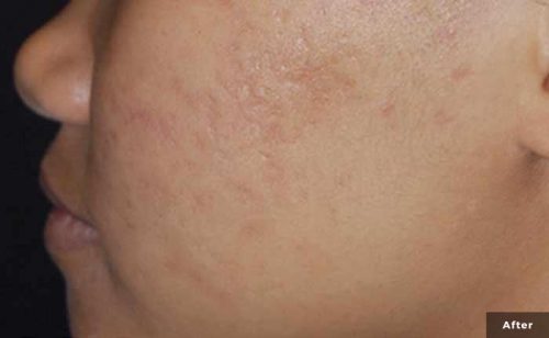 Skin Resurfacing Fort Lauderdale Skin Resurfacing Fort Lauderdale